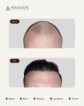 Slider image (6) Anagen - Hair Transplant Clinic in Switzerland